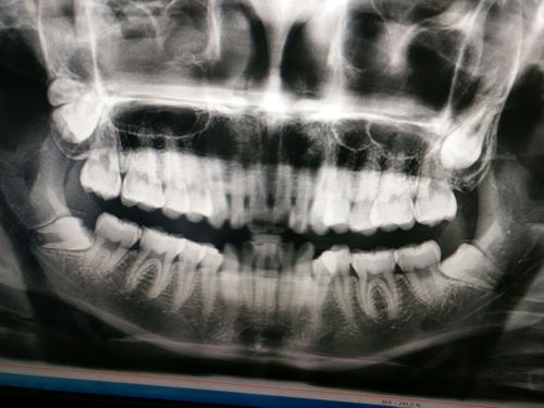 百度热搜长出的智齿能拔吗（拔智齿贴吧）