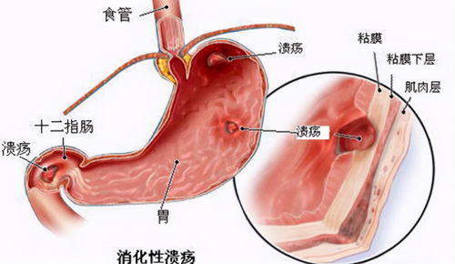 百度热搜肚子疼是胃还是肠道（肠胃炎热搜）